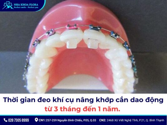 nâng khớp cắn niềng răng - ảnh 7