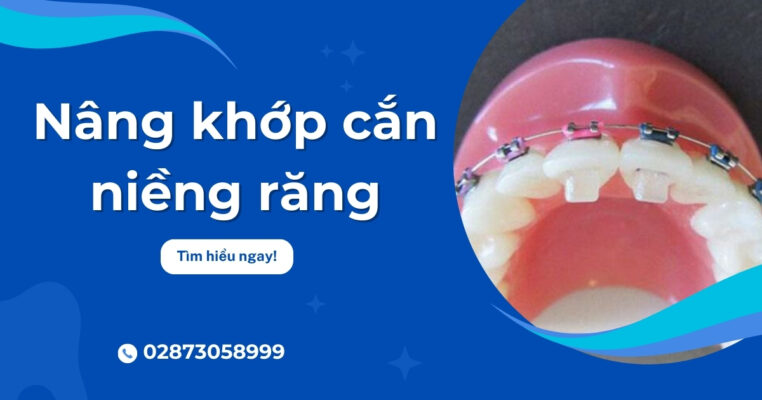 nâng khớp cắn niềng răng