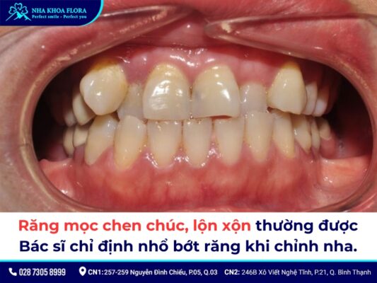 niềng răng có phải nhổ răng không - ảnh 1