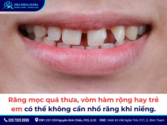 niềng răng có phải nhổ răng không - ảnh 2