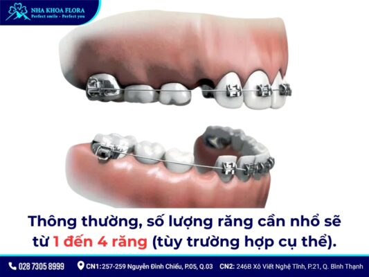 niềng răng có phải nhổ răng không - ảnh 3