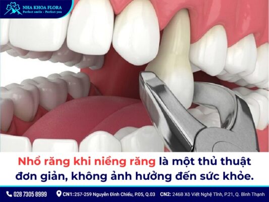 niềng răng có phải nhổ răng không - ảnh 4