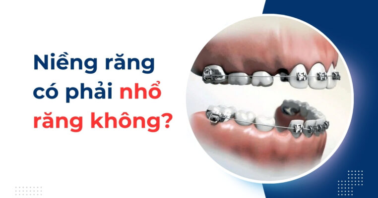 niềng răng có phải nhổ răng không