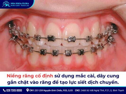 niềng răng có tháo ra được không - ảnh 1 niềng răng có tháo ra được không - ảnh 1