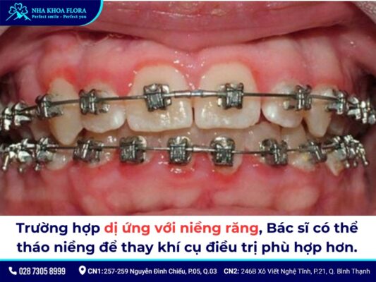 niềng răng có tháo ra được không - ảnh 4 niềng răng có tháo ra được không - ảnh 4
