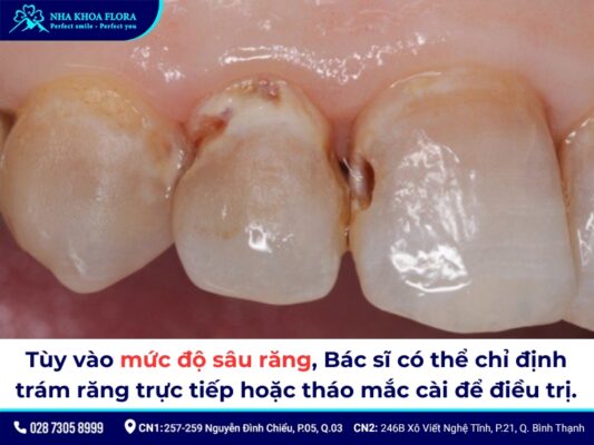 niềng răng có tháo ra được không - ảnh 5 niềng răng có tháo ra được không - ảnh 5
