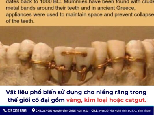 niềng răng thời xưa - ảnh 1