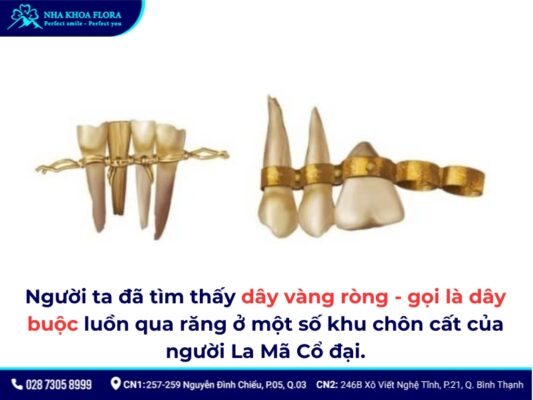 niềng răng thời xưa - ảnh 2