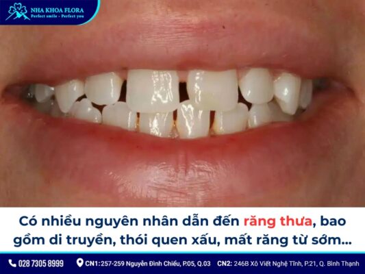 niềng răng thưa - ảnh 1