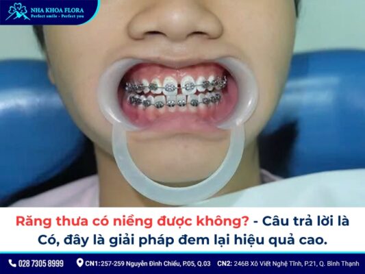 niềng răng thưa - ảnh 2