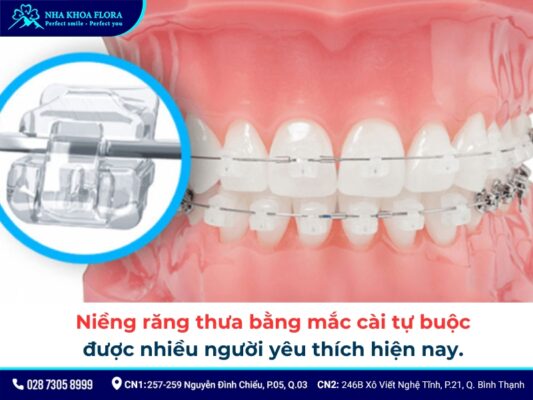 niềng răng thưa - ảnh 4