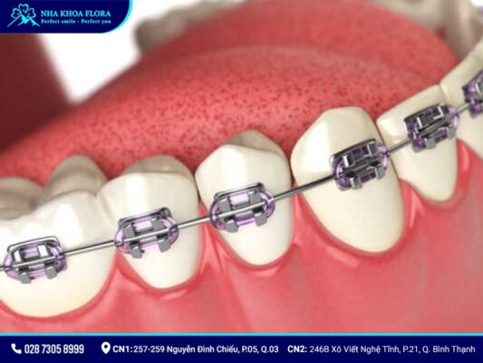 niềng răng thưa - ảnh 6