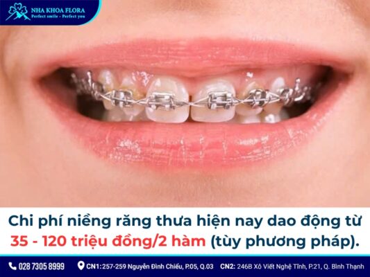 niềng răng thưa - ảnh 7