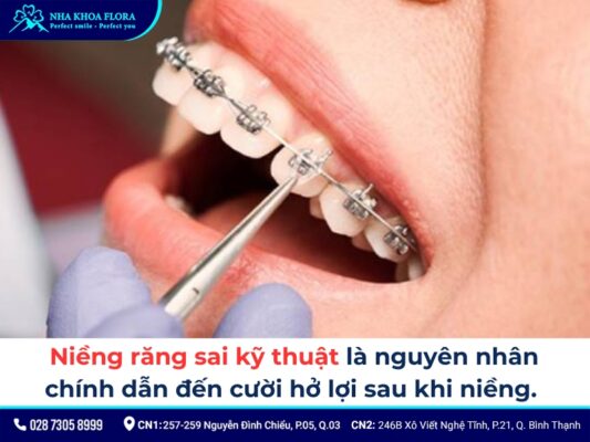 niềng răng xong bị cười hở lợi - ảnh 1