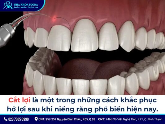 niềng răng xong bị cười hở lợi - ảnh 4