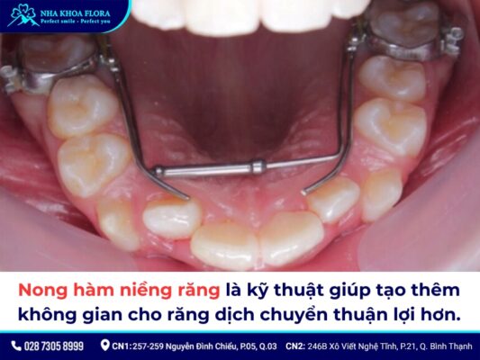 nong hàm niềng răng - ảnh 1