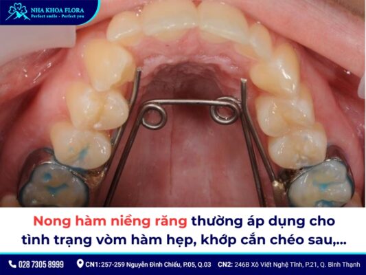 nong hàm niềng răng - ảnh 2