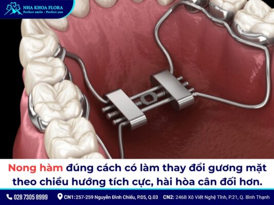 nong hàm niềng răng - ảnh 5