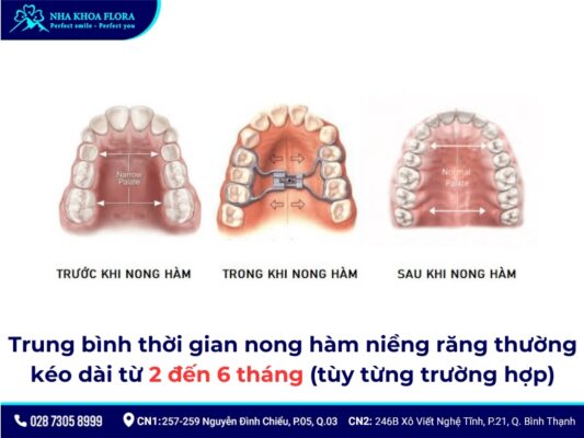 nong hàm niềng răng - ảnh 6