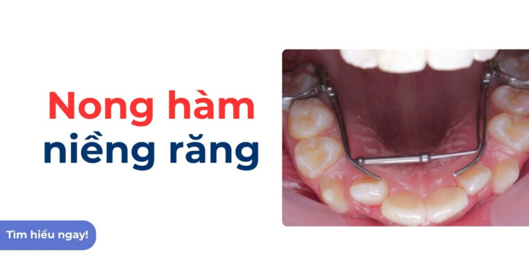 nong hàm niềng răng