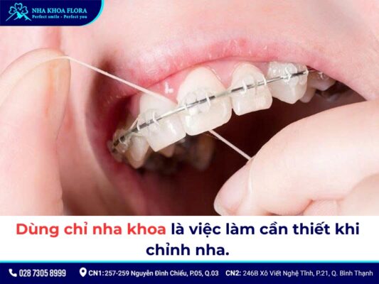 cách dùng chỉ nha khoa khi niềng răng - ảnh 2