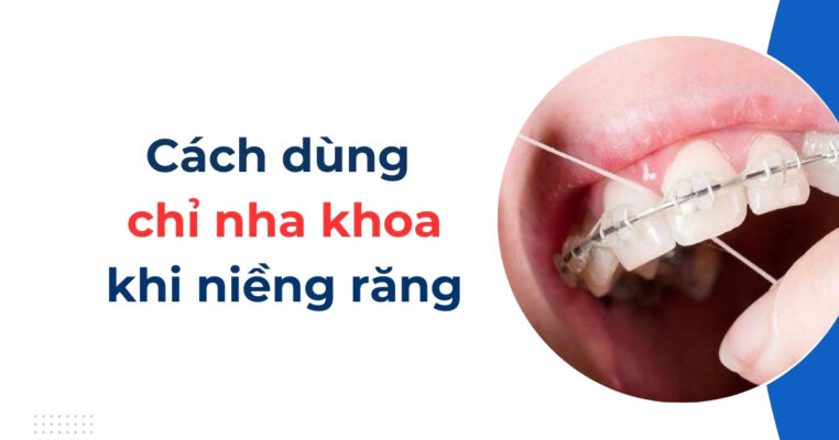 cách dùng chỉ nha khoa khi niềng răng