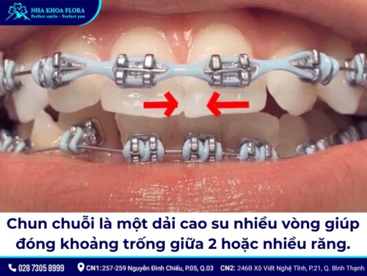 chun chuỗi niềng răng - ảnh 1 chun chuỗi niềng răng - ảnh 1