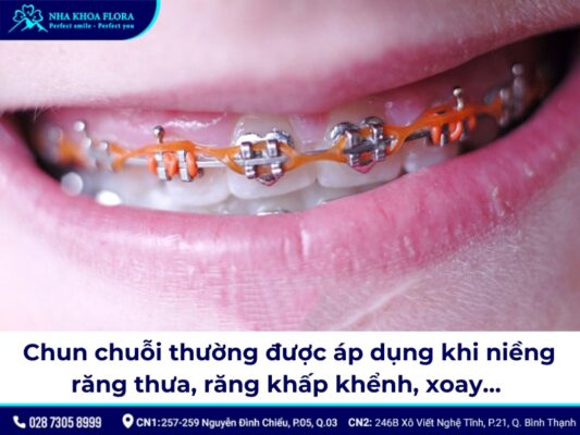 chun chuỗi niềng răng - ảnh 3 chun chuỗi niềng răng - ảnh 3