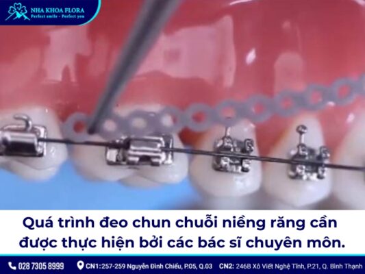 chun chuỗi niềng răng - ảnh 4 chun chuỗi niềng răng - ảnh 4