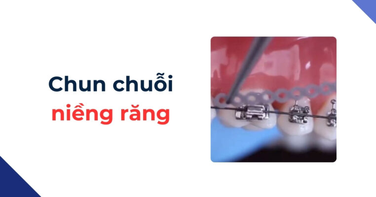 chun chuỗi niềng răng