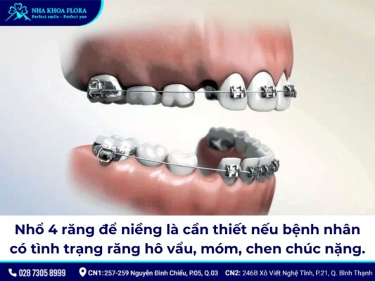 nhổ 4 răng để niềng răng - ảnh 1