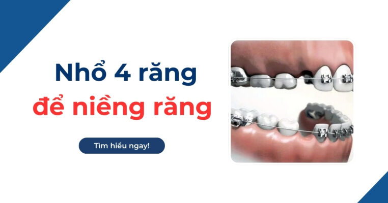 nhổ 4 răng để niềng răng