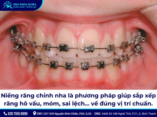 những trường hợp không được niềng răng - ảnh 1
