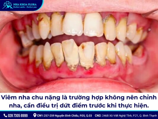 những trường hợp không được niềng răng - ảnh 3