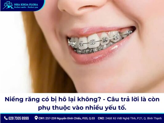 niềng răng có bị hô lại không - ảnh 1