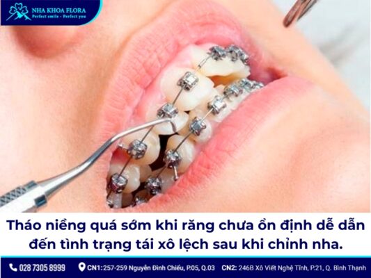 niềng răng có bị hô lại không - ảnh 4