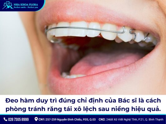 niềng răng có bị hô lại không - ảnh 6