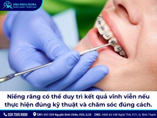 niềng răng có được vĩnh viễn không - ảnh 1