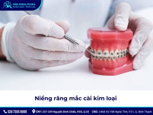 niềng răng có được vĩnh viễn không - ảnh 2