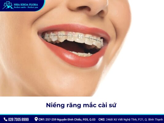 niềng răng có được vĩnh viễn không - ảnh 3