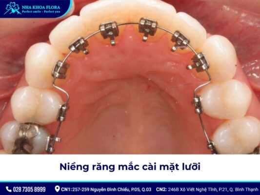 niềng răng có được vĩnh viễn không - ảnh 4