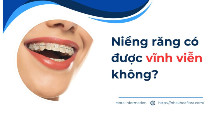 niềng răng có được vĩnh viễn không