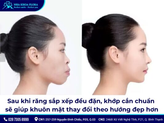 niềng răng có làm thay đổi khuôn mặt - ảnh 1