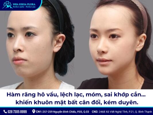 niềng răng có làm thay đổi khuôn mặt - ảnh 2