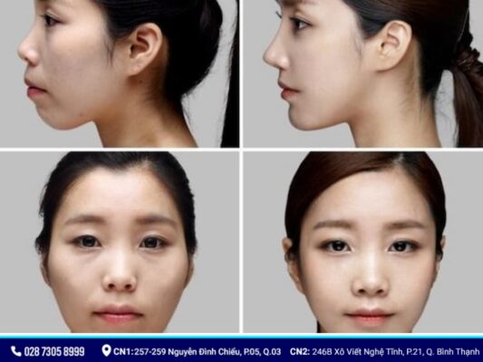 niềng răng có làm thay đổi khuôn mặt - ảnh 3