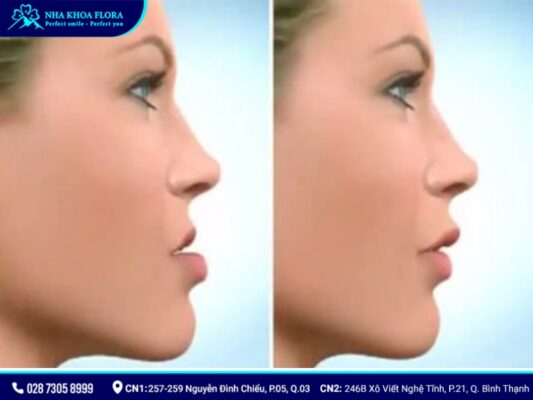 niềng răng có làm thay đổi khuôn mặt - ảnh 4