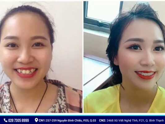 niềng răng có làm thay đổi khuôn mặt - ảnh 5