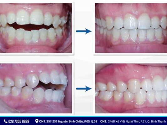 niềng răng có làm thay đổi khuôn mặt - ảnh 6