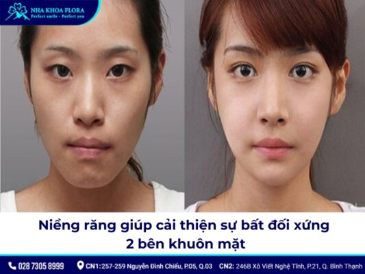 niềng răng có thay đổi xương hàm - ảnh 3