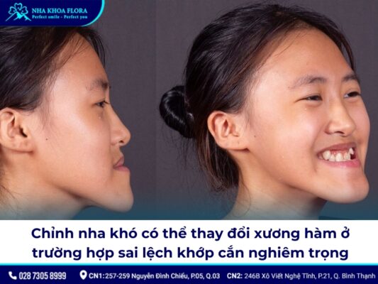 niềng răng có thay đổi xương hàm - ảnh 4